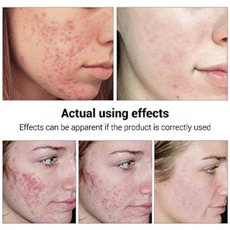 BREYLEE 17ml Herbal Organic Skin Care Serum Acne Treatment Essence Liquid Shrink Pores Repair Serum