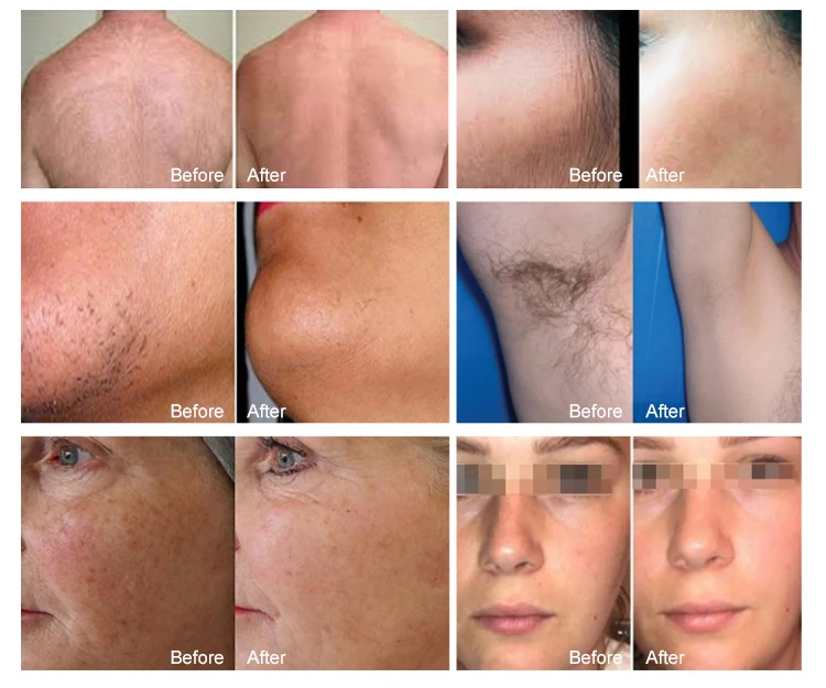 Vertical Permanent Ice Platinum 808 nm Titanium Beauty Equipment Diode Laser Hair Removal Machine