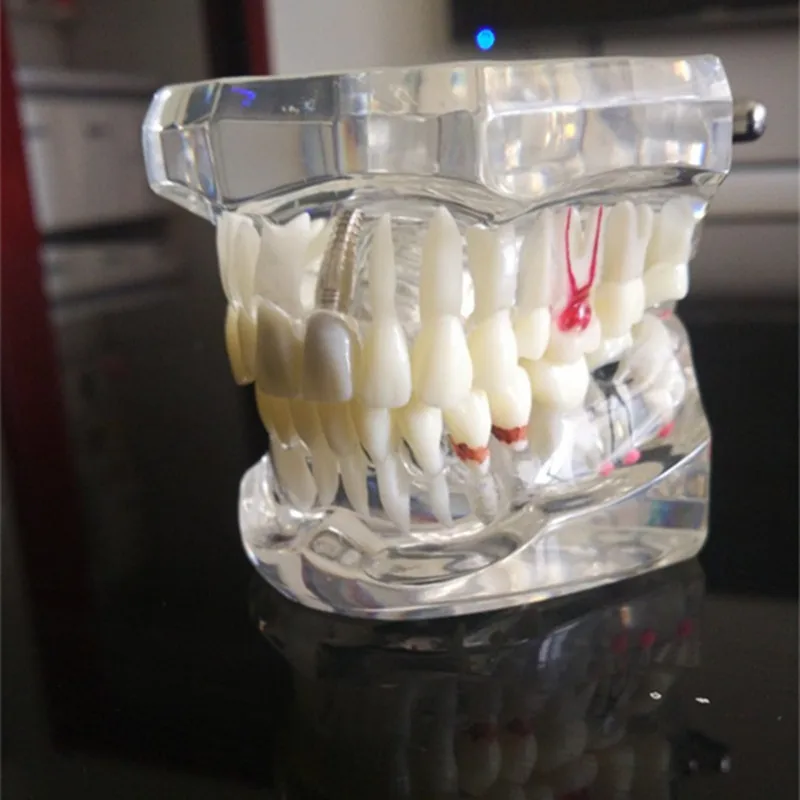teeth can be removable dental activity pathological model teeth model