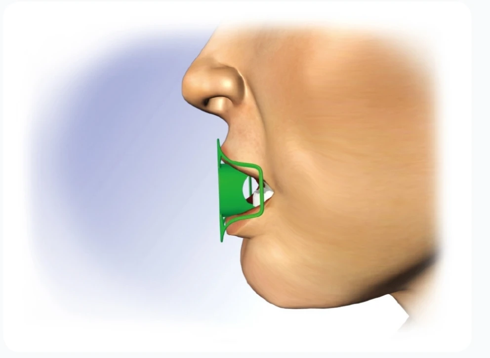 Single-use Medical Superior Design Non Sterile OXY CO2 Bite Block for Adult/Kids | Disposable Endoscopy Bite Block