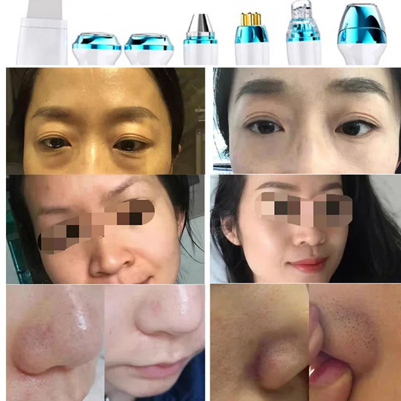 7 в 1 hydra Blackhead Extraction гидроокислительняа установка для лица с очищающим средством Hydra микродермабразия