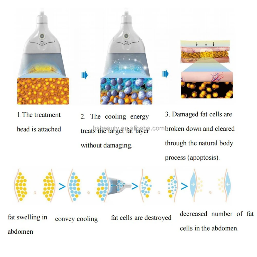 Aesthetic Medicine 360 Vertical Criolipolisis Cryo Cool Body Sculpt With 7 Silicone Heads / Cryolipolyse Machine Price