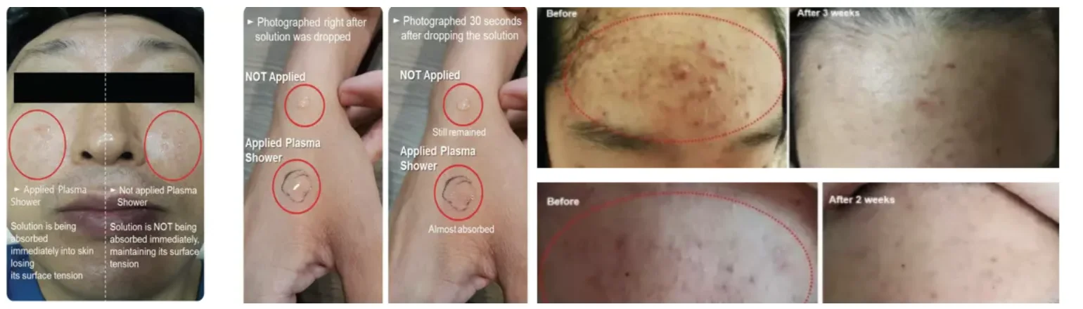 Medical 3 in 1 fibroblast ozone plasma pen jet plasma lift eyelid plasma shower for acne scar removal skin tightening