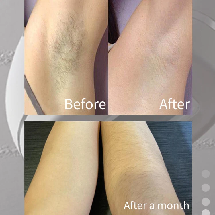 Portable Wireless ipl Handset Permanent Laser Woman Hair Removal Lazer Painless Laser Perman IPL Hair Removal Home Device Laser