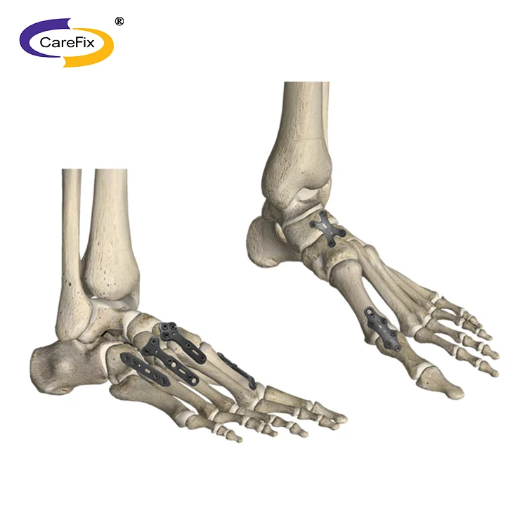 Straight Locking Mini Plate screw for foot ankle elbow fracture LCP meditech orthopedic implants