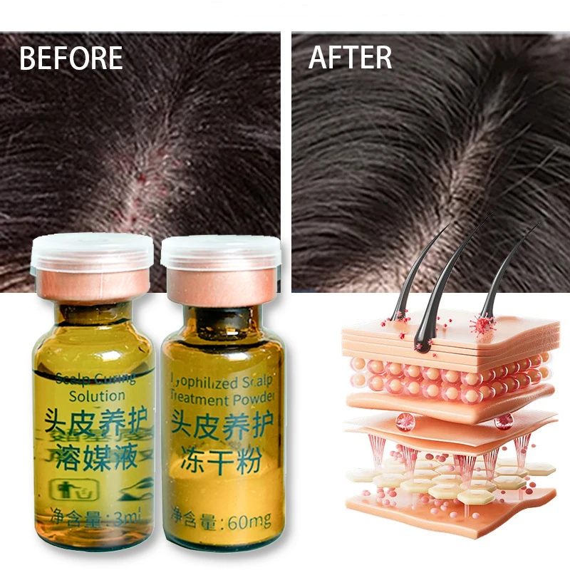 ZS Wholesale Scalp Relief Anti-Dandruff Lyophilized Powder Follicle Repair Deep Cleaning Anti-Hair Loss Hair Growth Serum