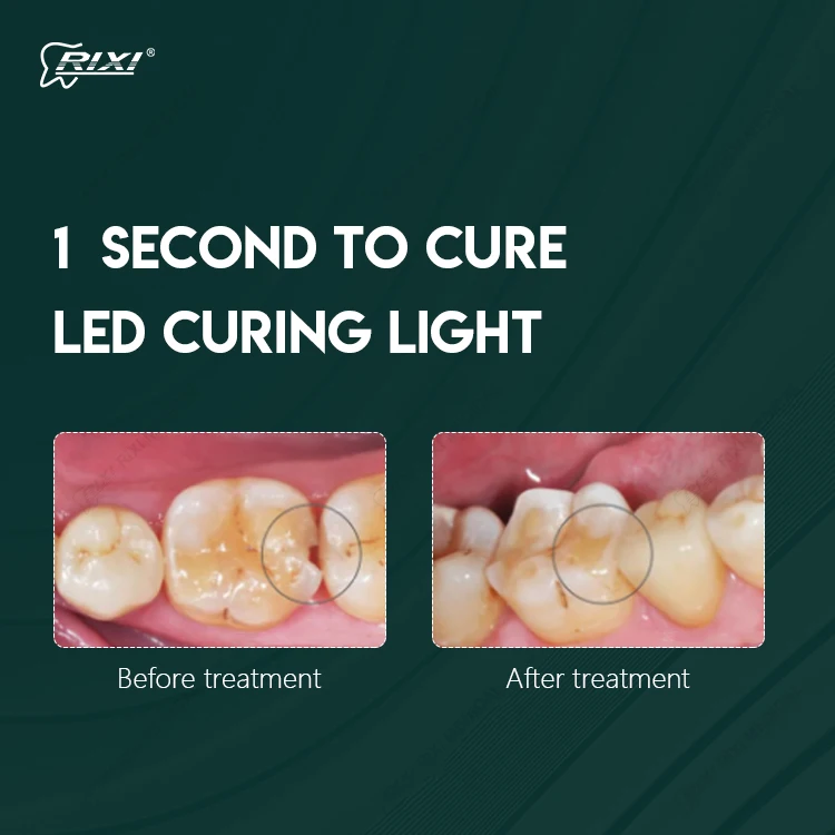 1s Dental Light Cure Machine Wireless Dental Light Curing Lamp for Teeth Filling LED Light Cure Dental