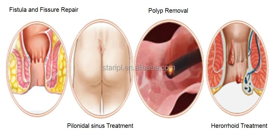 Surgery no Bleeding 1470nm Proctology Hemorrhodis Fistula Laser Sugery Machine With 600um Radial Fiber 600um Conical Fiber