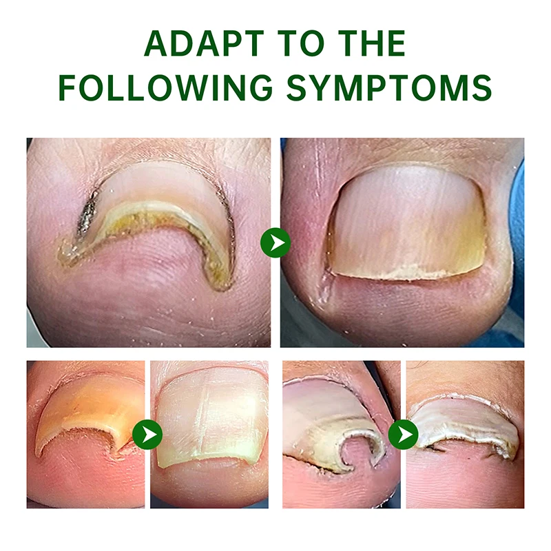 Private Label Nail Treatment Oil Anti Infection Paronychia Onychomycosis Feet Care Nail Fungus Removal Gel Care