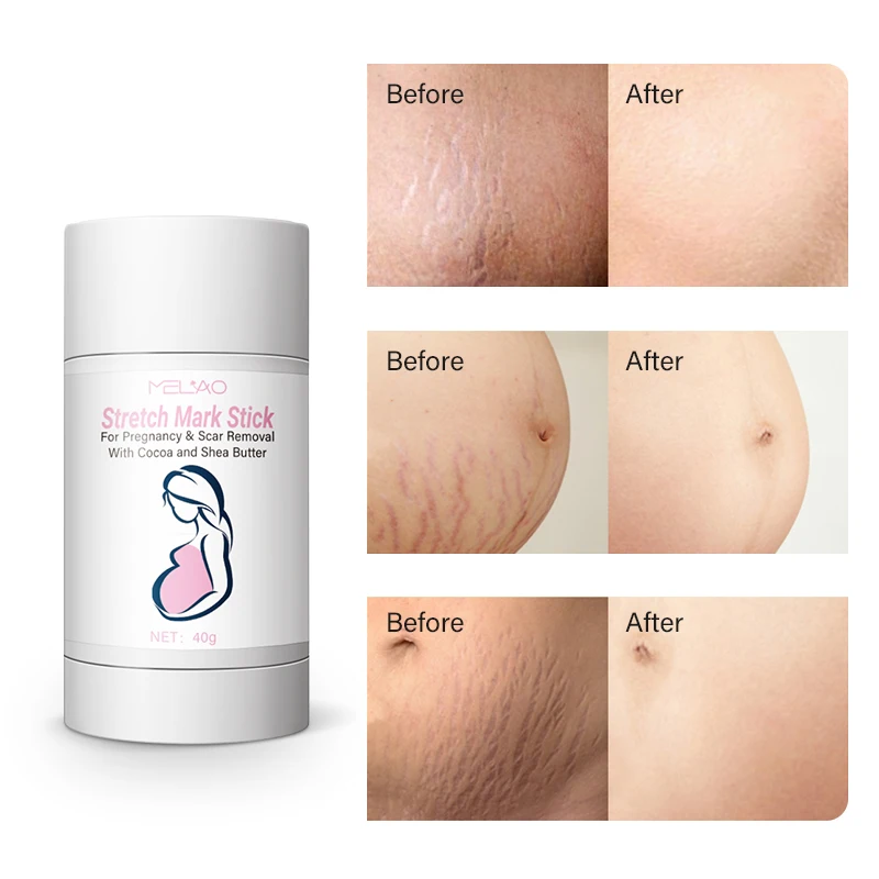 Custom Logo Private Label Manufacturer Stretch Mark Stick Scars Removal Stretch Mark Roll On Stick