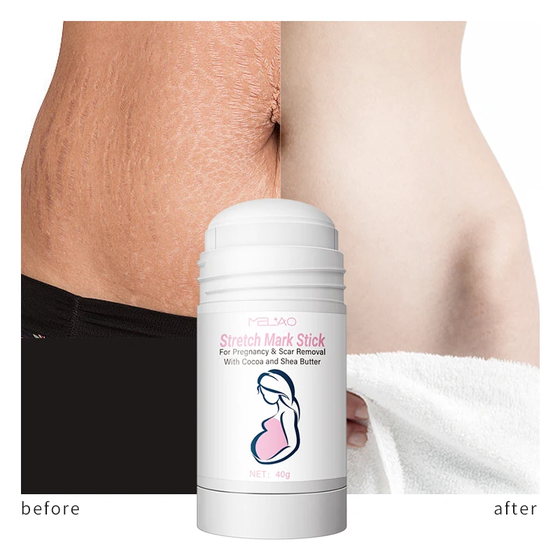 Custom Logo Private Label Manufacturer Stretch Mark Stick Scars Removal Stretch Mark Roll On Stick