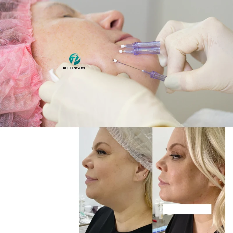 CE Korea PDO thread face lift thread tornado cog 3d 4d 6d pdo thread for medical skin tightening