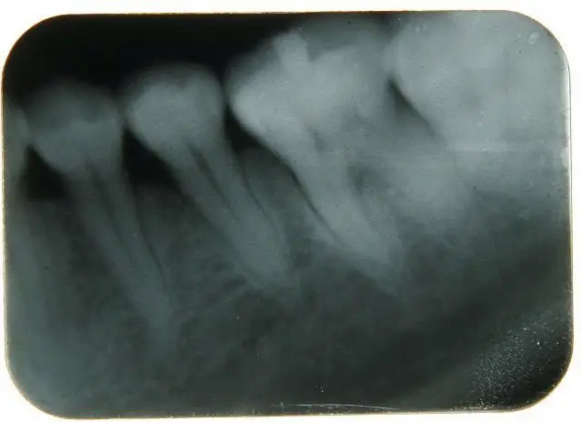  Горячая продажа equipos денталес стоматологическая рентгеновская машина да звезда пленка