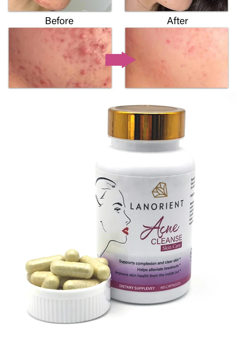 TEEN ACNE Vitamin Supplement Natural Immune Antioxidant Anti-aging Pigmentation Skin Whitening Capsules
