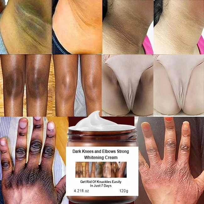 New Arrival Niacinamide Dark Knees Knuckles Elbows Armpit Whitening Cream,Woman Private Parts Bleaching Cream for Dark Skin
