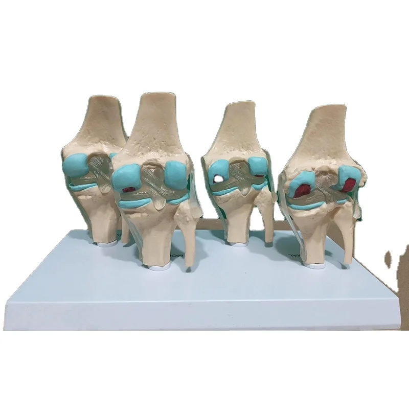 factory human skeleton anatomical bone teaching model 4-stage diseased knee joint model