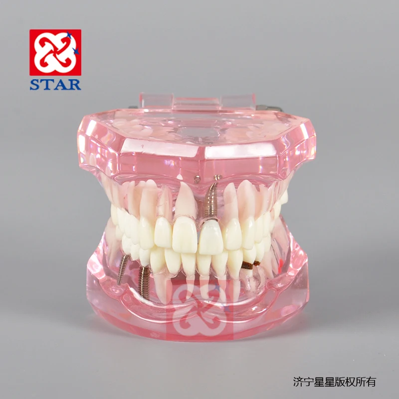 Implant restoration pathological dental model for demonstration