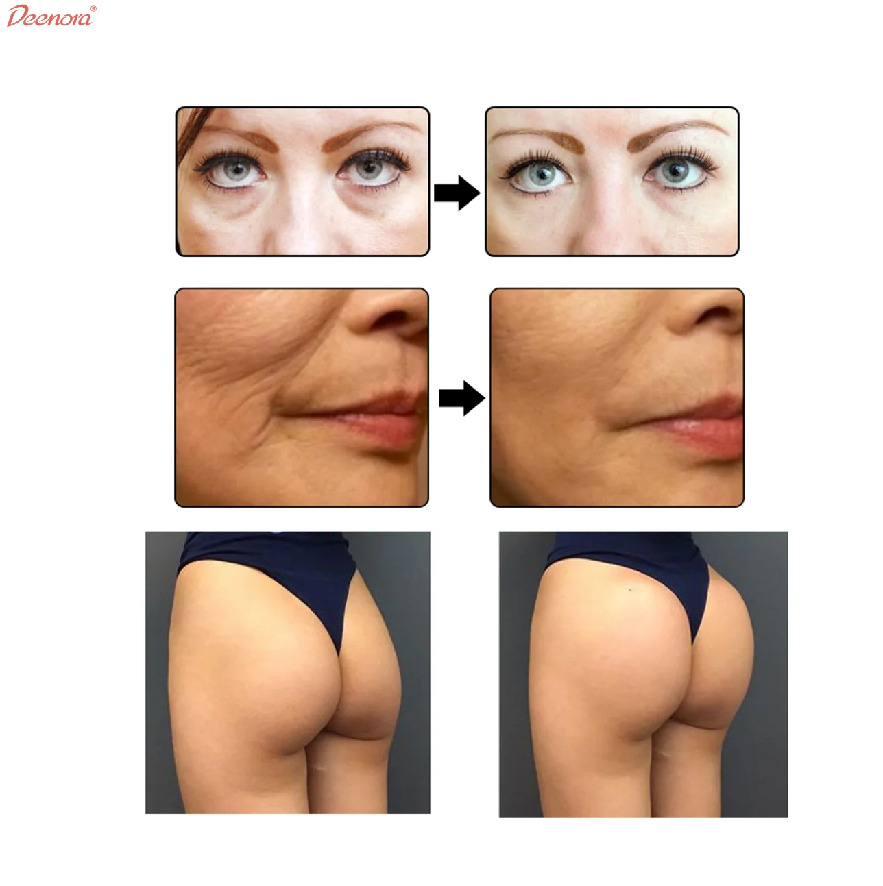 Deenora most popular 2ml injectable cross linked korea neuramis hyaluronic acid dermal fillers for face care penis enlarge