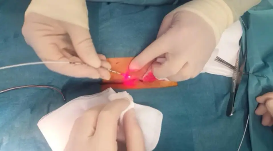 fistula laser (2).jpg