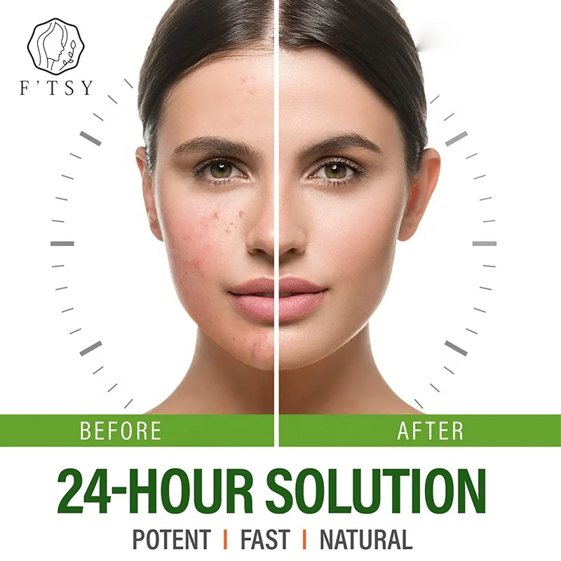 Noticeable Moisture Heal and Recover Blackheads Spot Treatment Tea Tree Oil Natural Cystic Pimple Acne Dark Spot Cream for Face