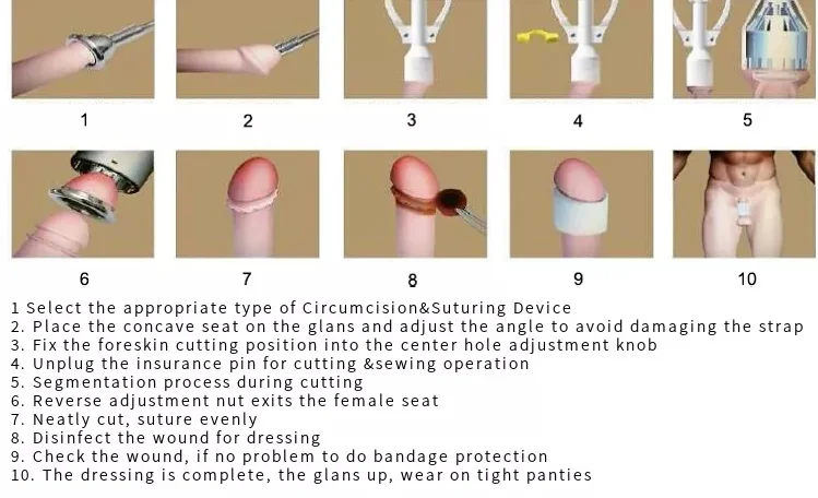 disposable circumcision stapler urology