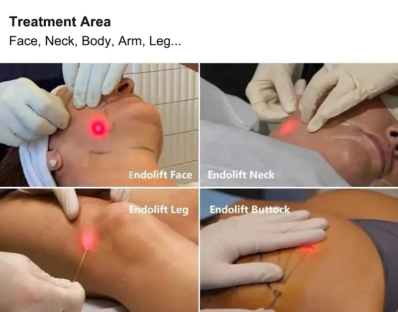 Best Quality Endolaser Diodo 980 Nm 1470 liposuction Diode Laser 980 1470 Nm For lipolysis 1470 Diode Laser fat reduction