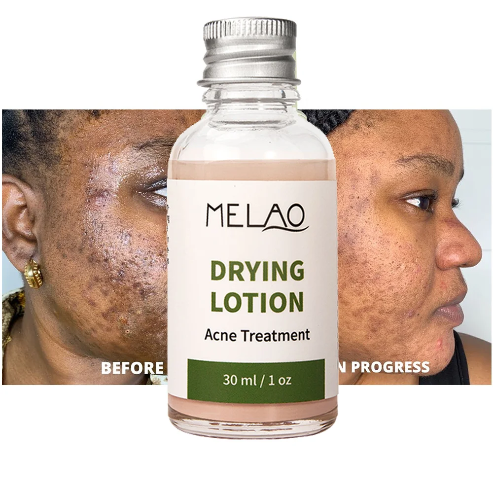 OEM/ODM High Quality Private Label Facial Care Natural Organic Acne Treatment MELAO Oil Balance Drying Lotion Acne Treatment