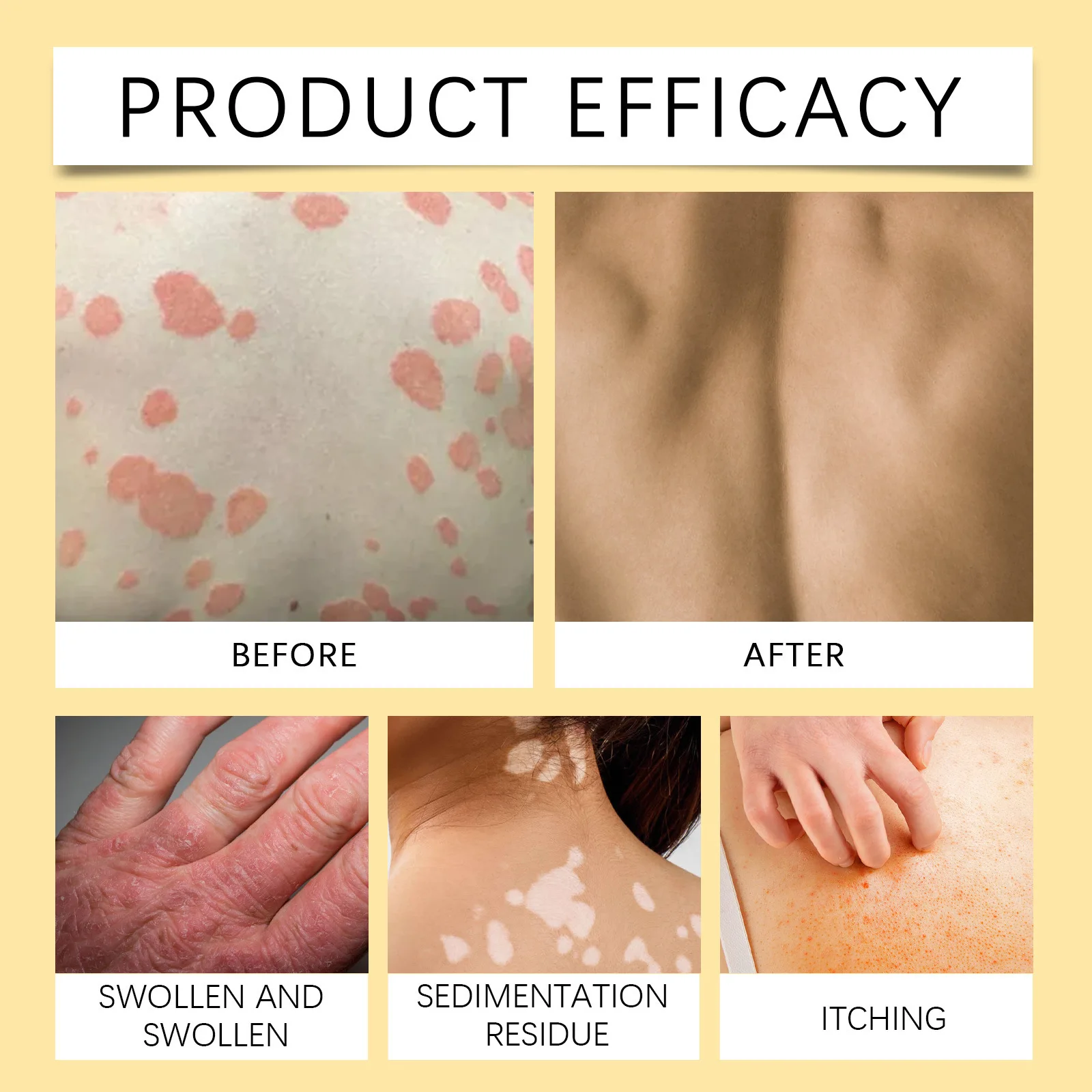 Private label BEE VENOM 20g psoriasis ointment acne dermatitis scrotum eczema pityriasis urticaria psoriasis treatment cream