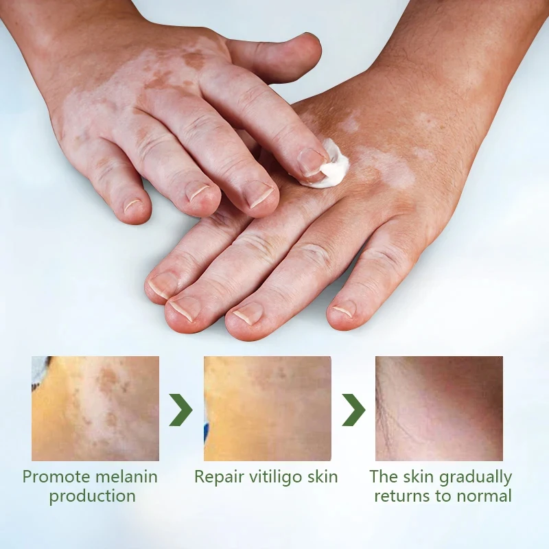 20g Herbal Extract Vitiligo Ointment Remove Ringworm White Spot Removal Skin Leukoplakia Disease Vitiligo Treatment Cream
