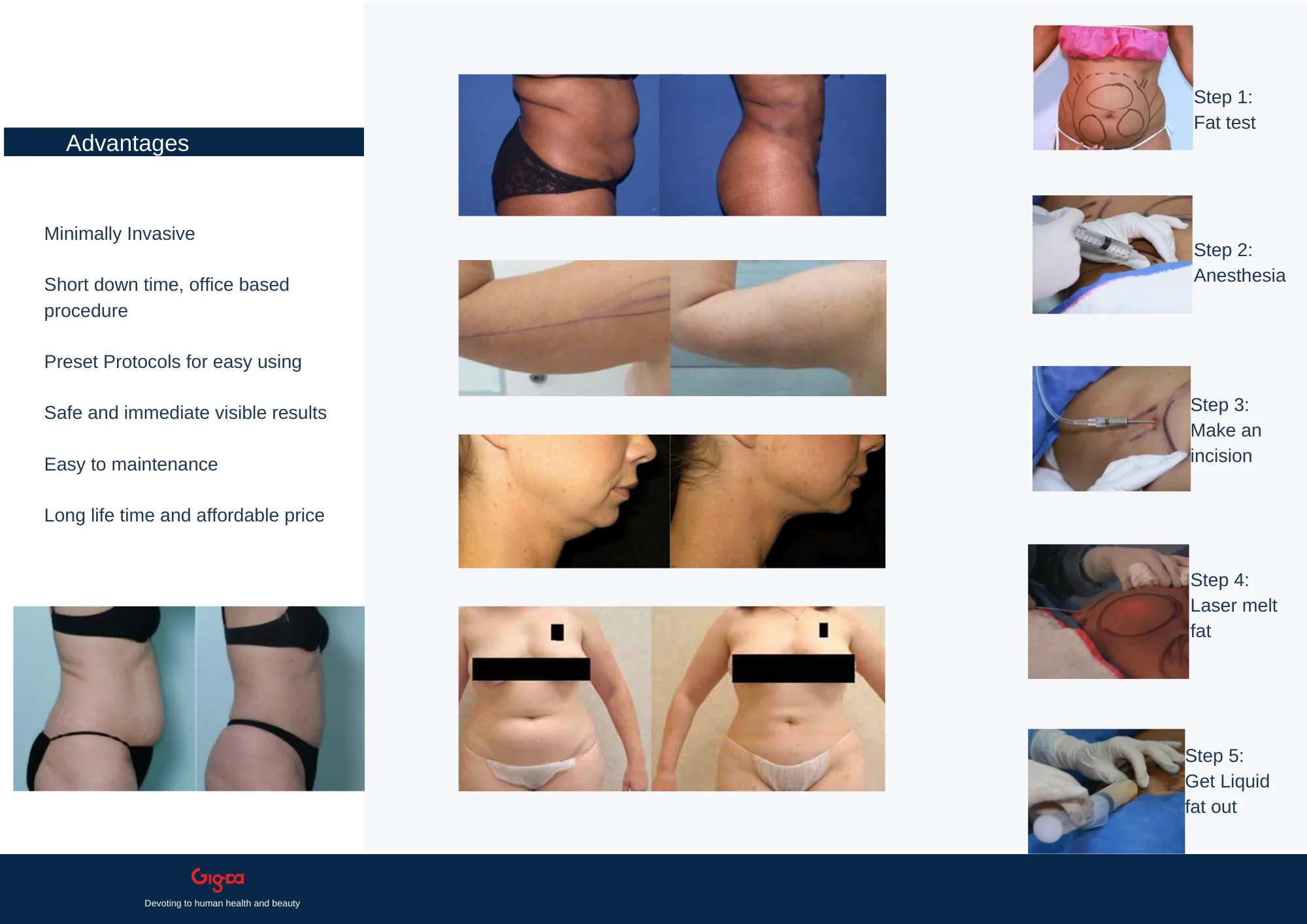 Portable 1470nm 980nm Endolifting Diode Laser Lipolysis Liposuction Fiber Lipolysis Fat Reduce Beauty Equipment