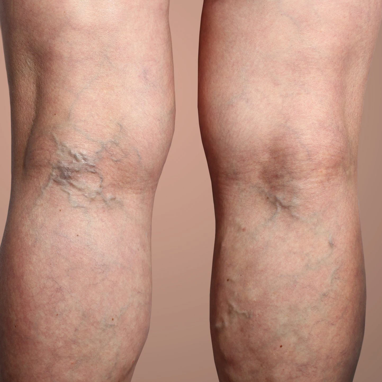 Hot Sale Model 980nm1470nm Double Wave Diode Laser For The Treatment Of Varicose Vein Vascular Disease