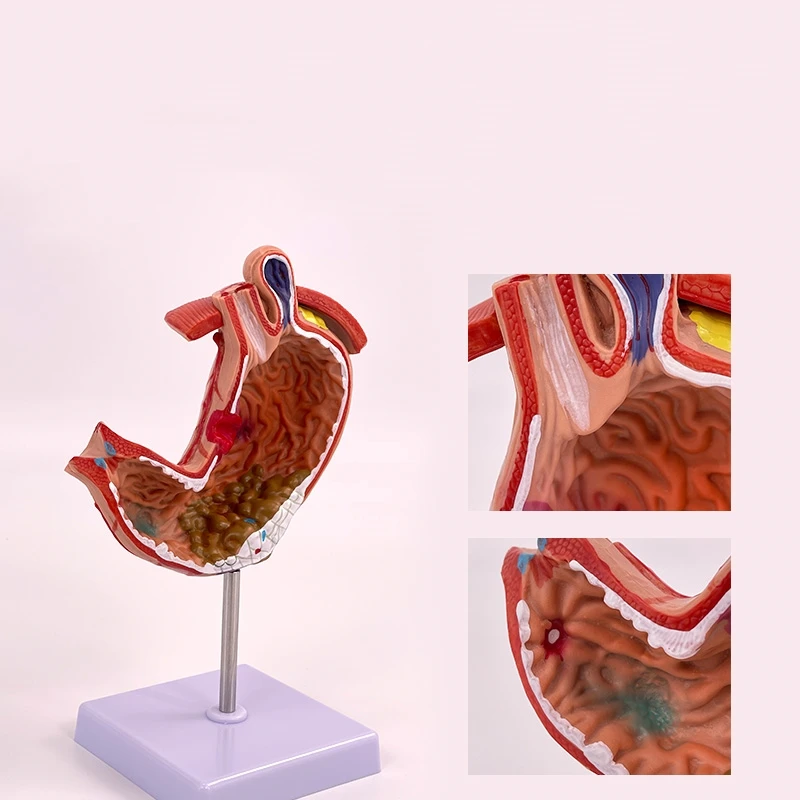 Medical Stomach Demonstration Human Stomach Anatomy Pathology Gastric Digestive System Model Gastroenterology Toy Model