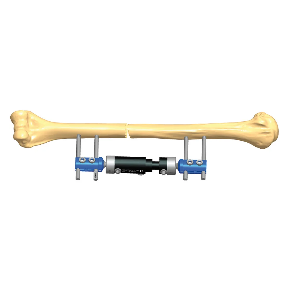 
2021 Black Stainless Steel Micro Movement Fixator 