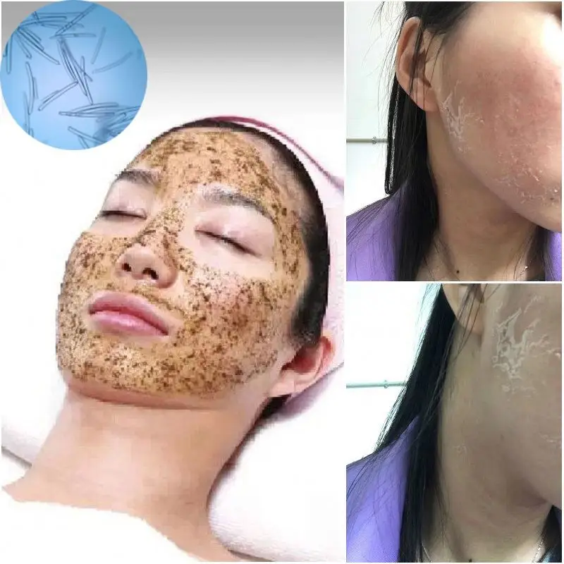 Hot sale 70% Treatment III Spicule Spongilla Spicules Acne skin Cream with Sea Buckthorn Oil