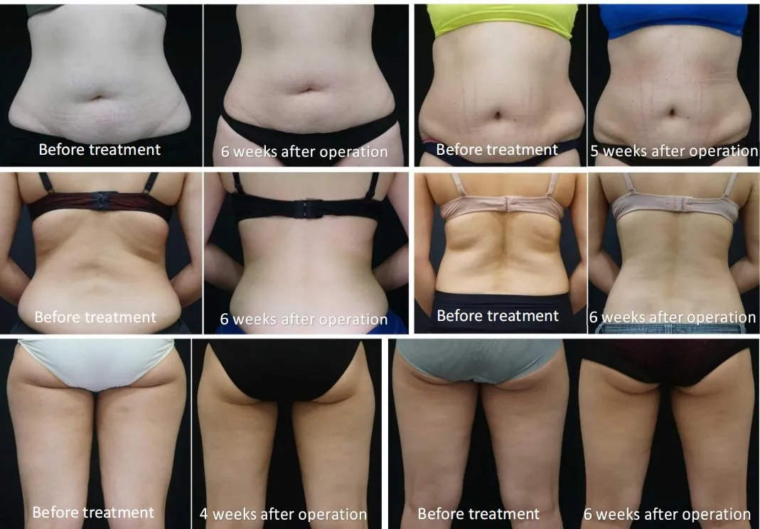 New Trending Fat freezing double chin kryolipolyse slimming machine / kryolipolyse 360
