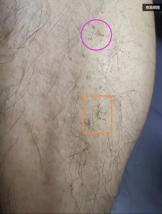 1064nm ND YAG Laser Epilation Alexander laser 755nm Gentle Alex Pro Alexandrite Laser Hair Removal machine