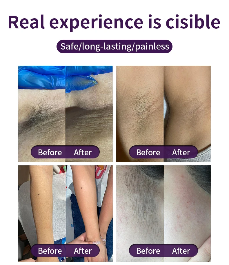 Big promotion women 600W- 1800W laser diodo hair removal triple wavelength diode laser hair removal