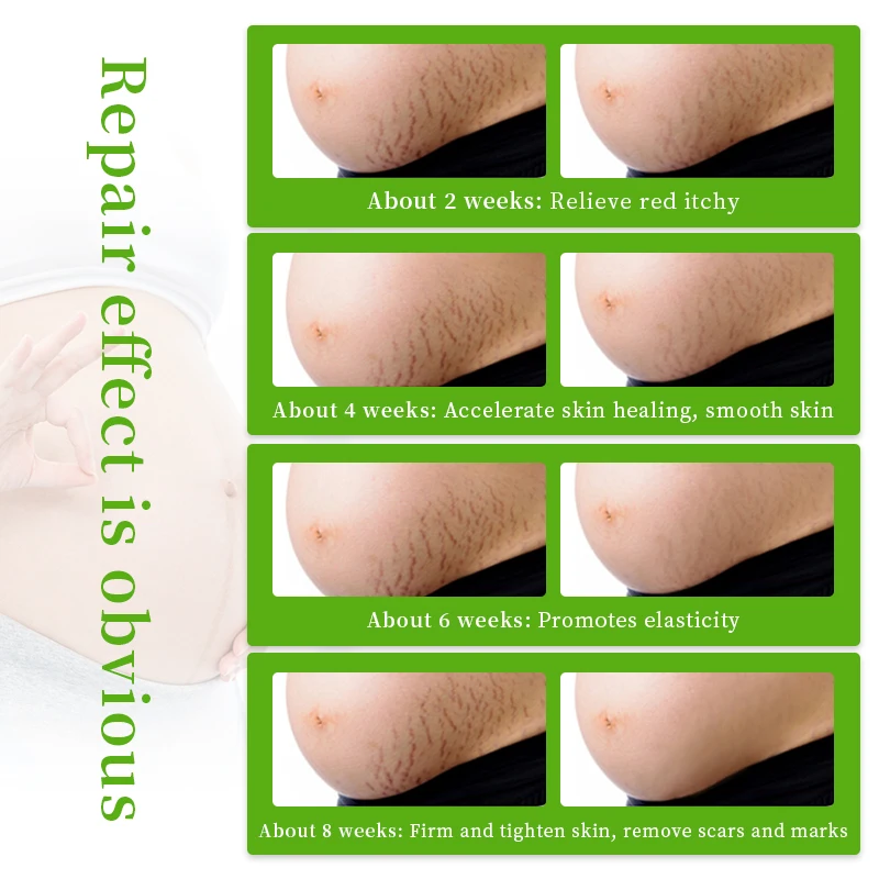 Stretchmark Remover Cream Natural Organic Body Scar Pregnancy Repair Body Anti Scar Removal Stretch Mark Cream
