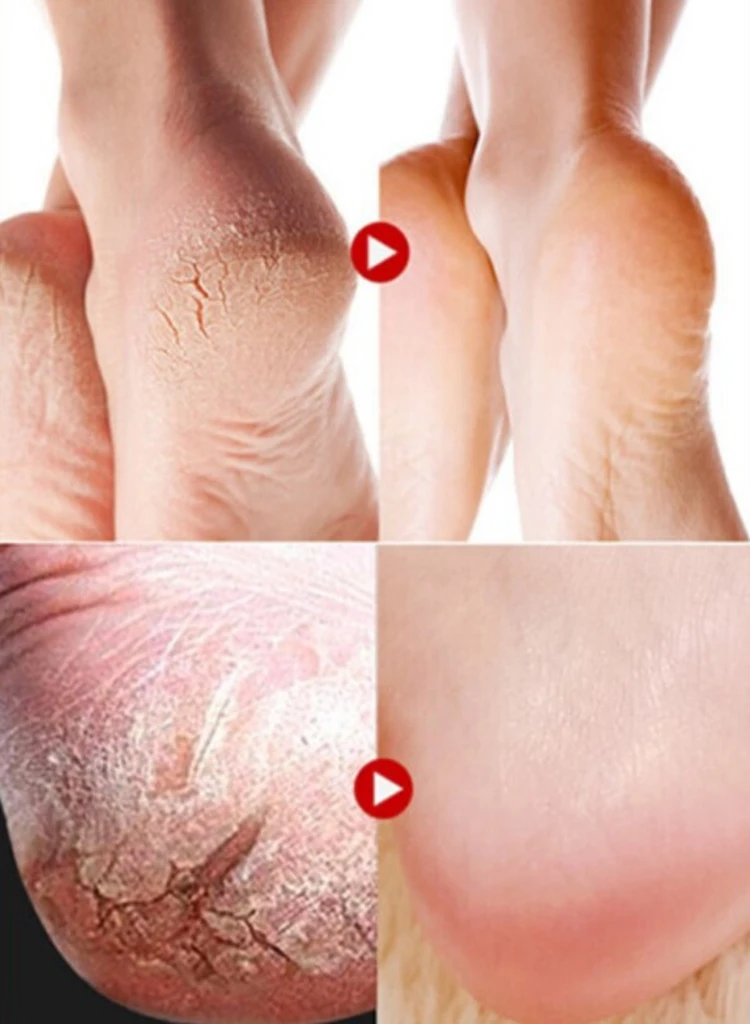 Cracked Heels Dry Hands Skin Softener for Dry Feet Hands Hydrating Smoothing Healthy Feet Moisturizer Dryness Relief Foot Cream
