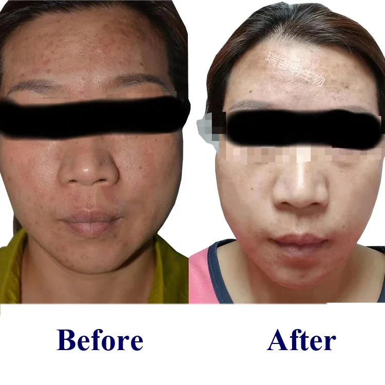 private label MESO PDRN  facial serum Skin Rejuvenating Serum for Anti Wrinkles Skin Hydration