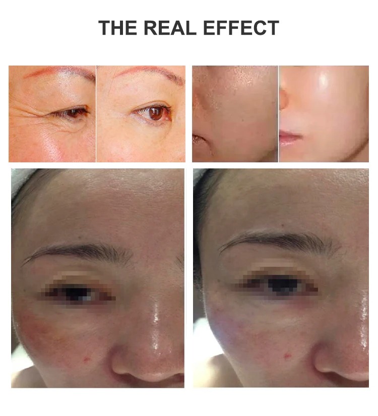  Best Selling with No Needle Mesotherapy Face Cleaning