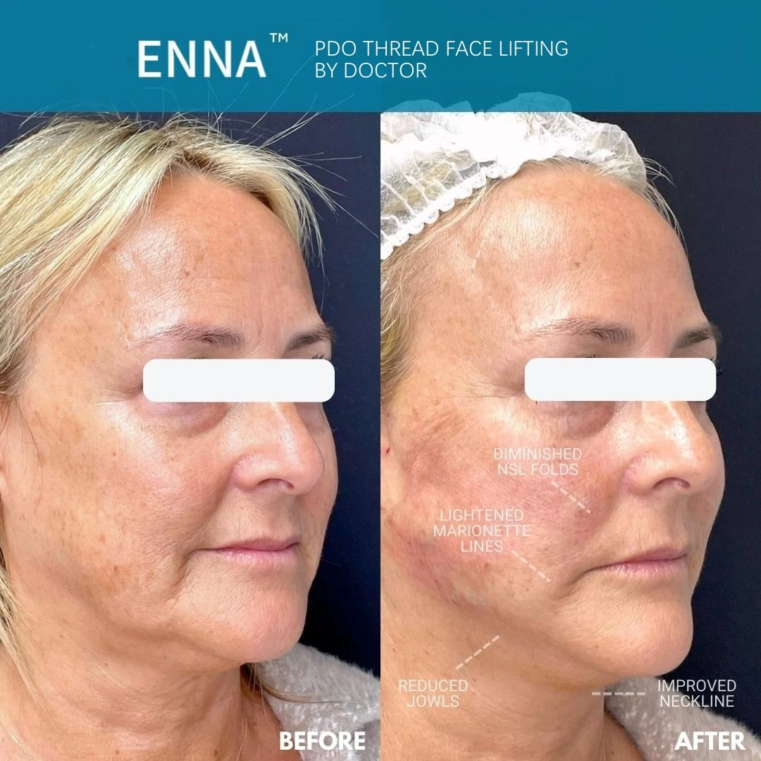 ENNA minerva pdo mono high quality lift korea magical mono surgical sutures absorbable pga surgical sutures pdo thread