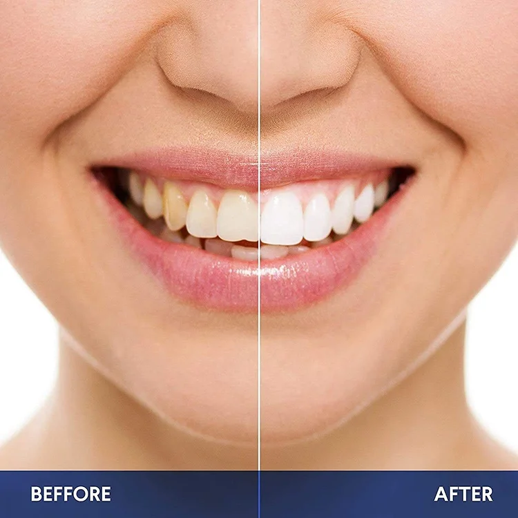 Wholesale oral care teeth whitening gel private label natural teeth whitening kit professional led teeth whitening kit