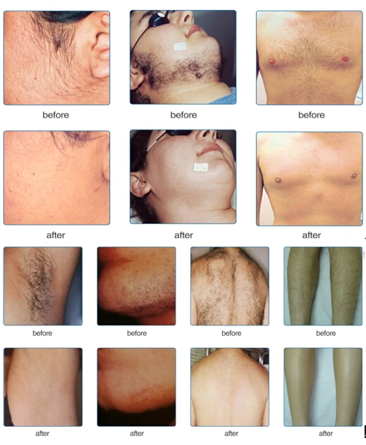 2023 Sincoheren 808 755 1064nm Permanent And Painless Hair Removal Diode Laser 808nm diode laser hair removal beauty machine