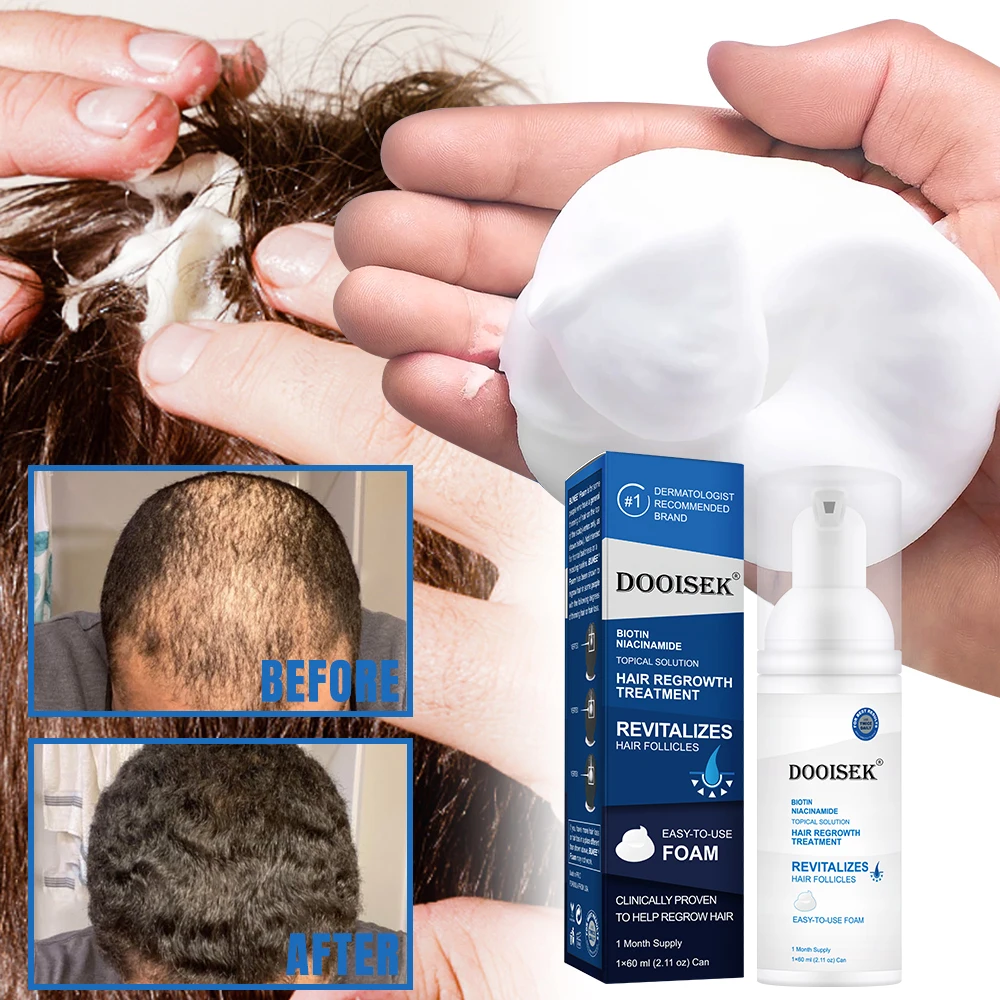 Hot selling OEM ODM 60ML Hair Regrowth Foam Hair Growth product Anti-Loss Custom Hair Growth Oil