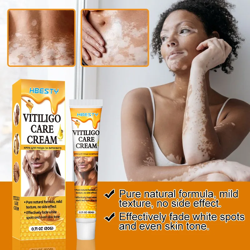 HBESTY Effectively Remove Vitiligo Ointment Remove Ringworm White Spot and Vitiligo Skin Care Product