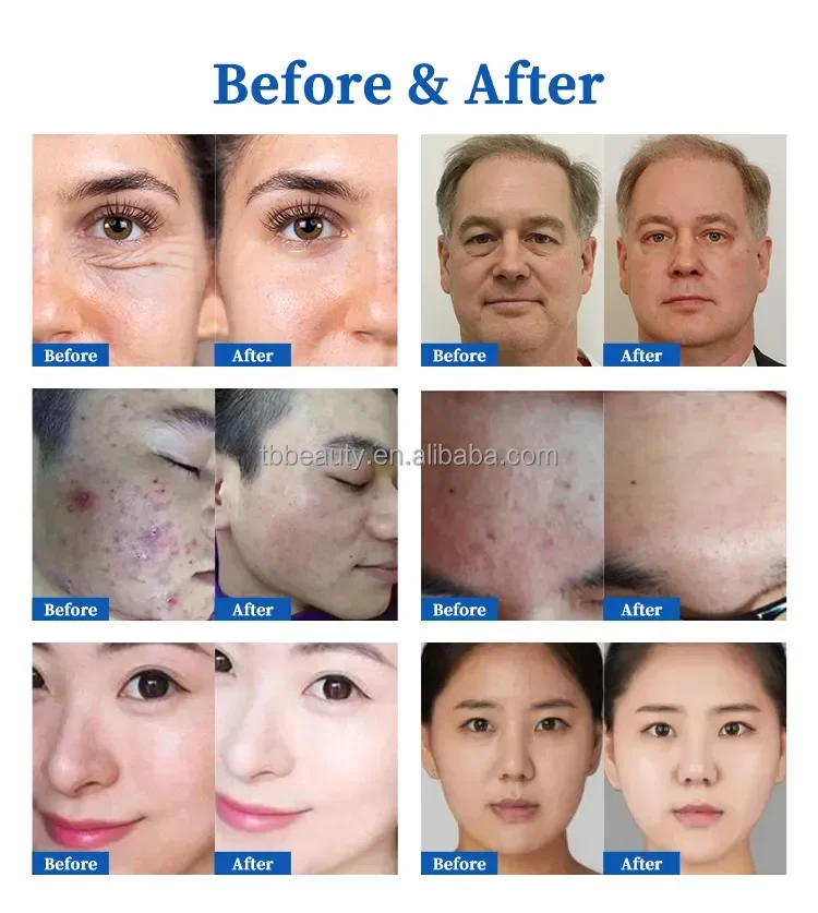Newest 3 In 1 Plasma Ems Rf Acne Removal Ozone Plasma Eyelid Neck Face Lift Plasma RF Skin Tightening Rolling Machine