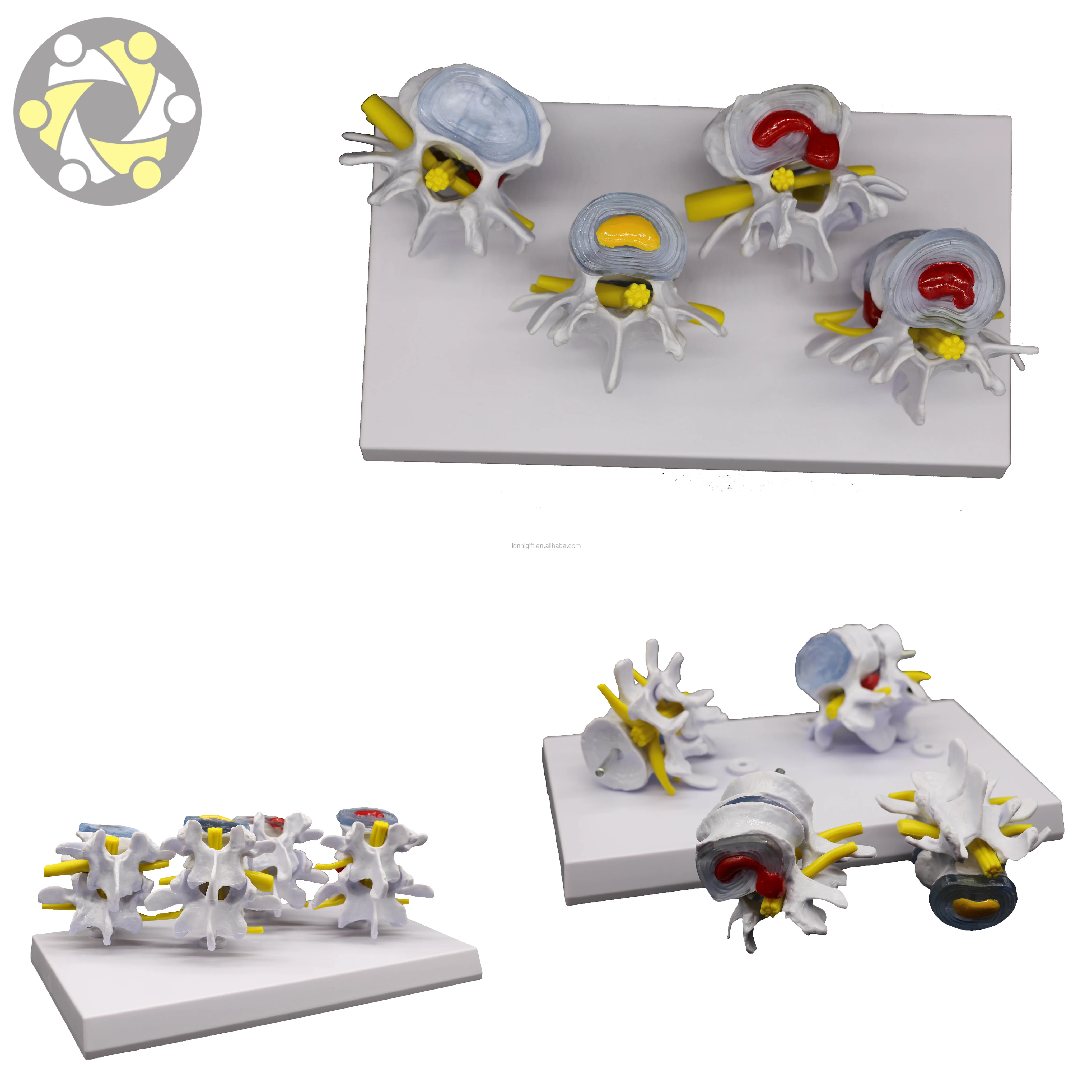 Medical Science 4 Stage Pathological Lumbar Skeleton Model