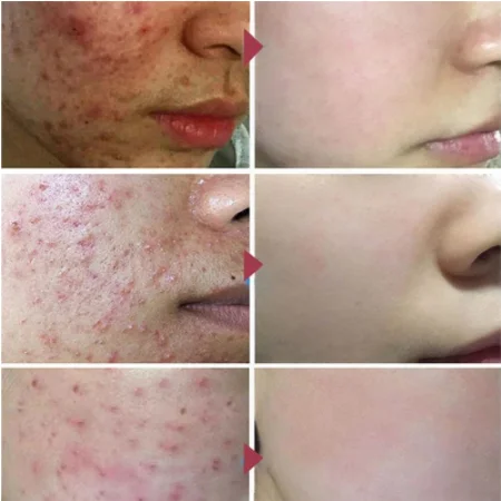 Herbal Acne Removal Face Cream Oil Control Anti-Acne Gel Treatment Acne Mark Skin Care Whitening Eliminate Pimples Facial Cream