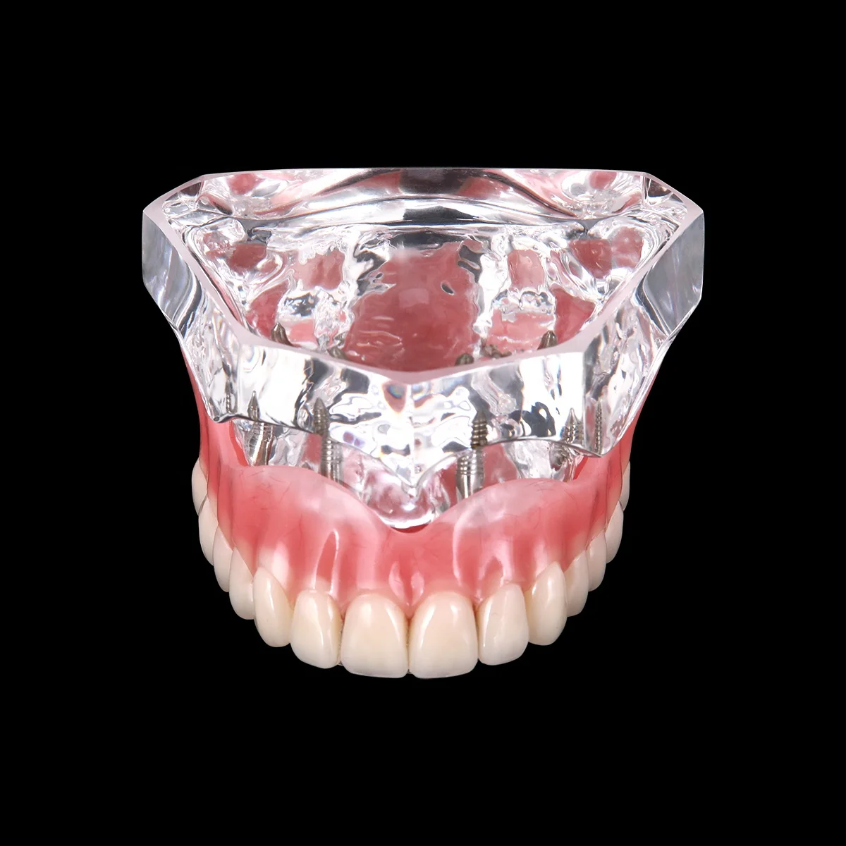 Hot Selling Dental Implant Teeth Model Overdenture Restoration with Implants Upper